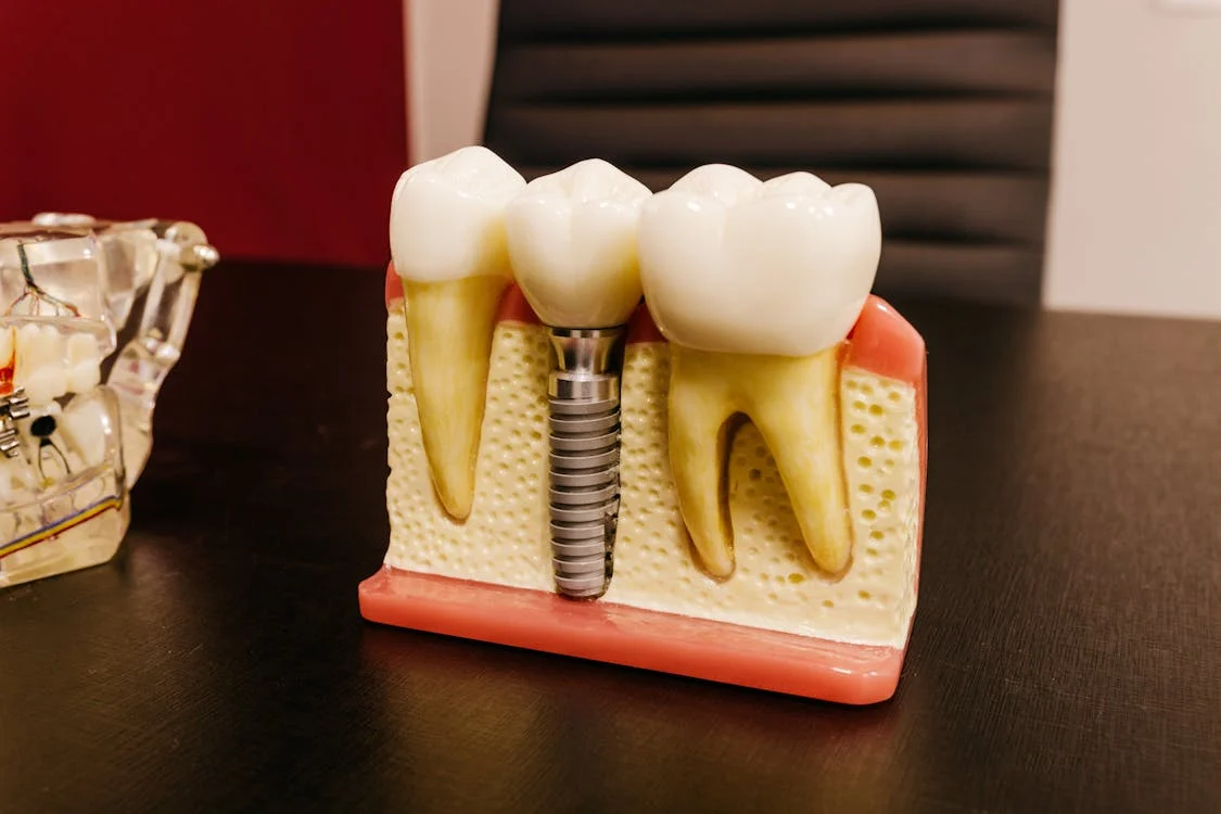 Dental Implants for False Teeth: A Long-Term Cost-Effective Solution