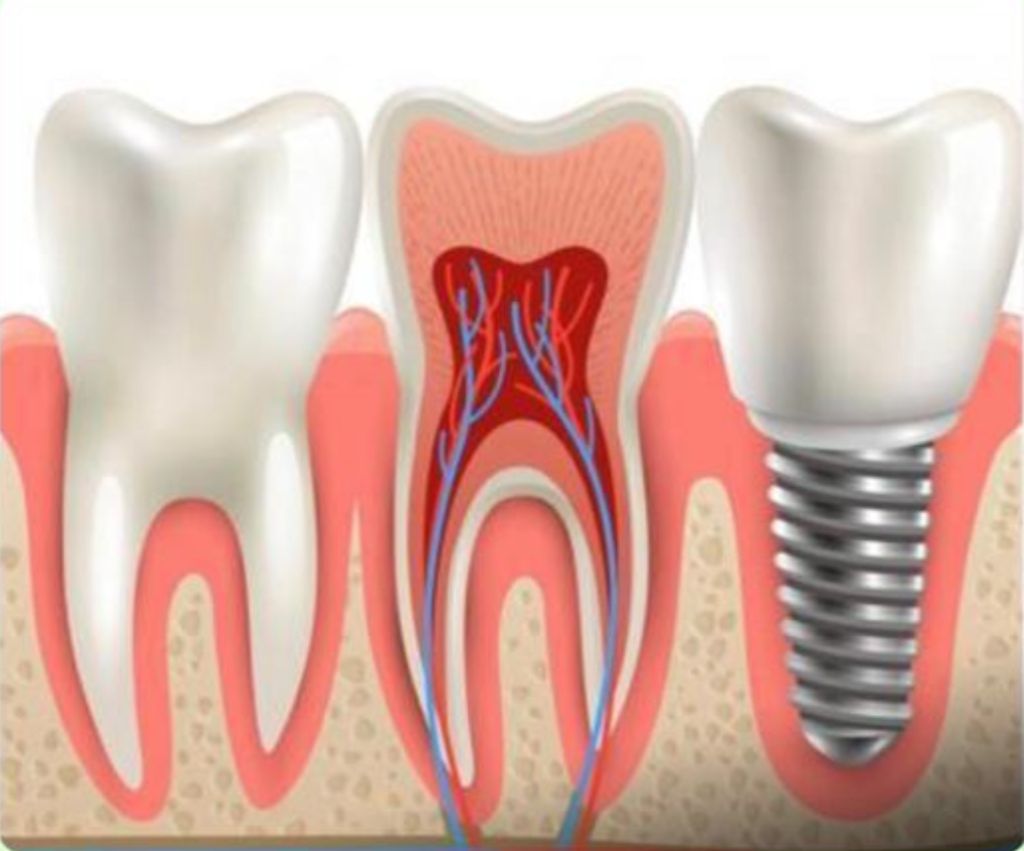 Dental Implants