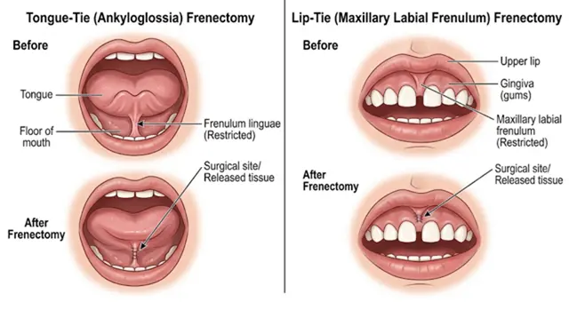 Frenectomy (Tongue-Tie / Lip-Tie)